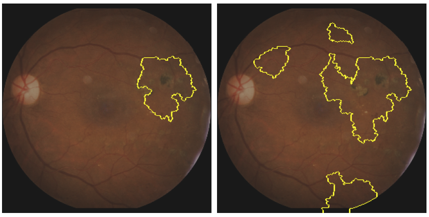 Medical imaging: Explainability methods for image classification